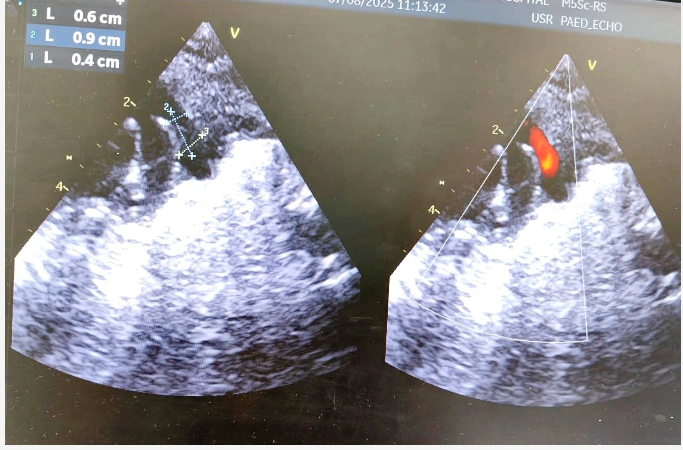 A premature infant's large PDA was successfully closed with a percutaneous device in Howrah, West Bengal, improving cardiac and respiratory function.